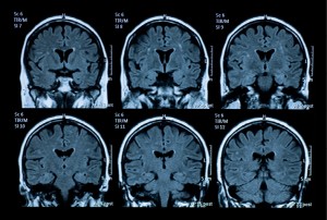 Brain_scan